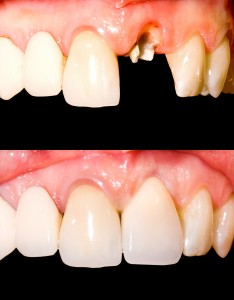 antes e depois implantes dentarios