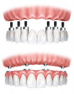 all on 4 implantes dentarios
